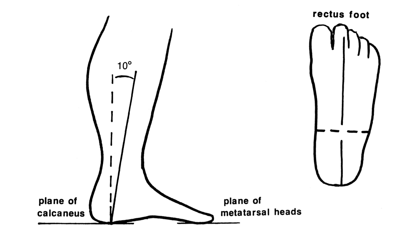 Pathomechanics of Structural Foot Deformities