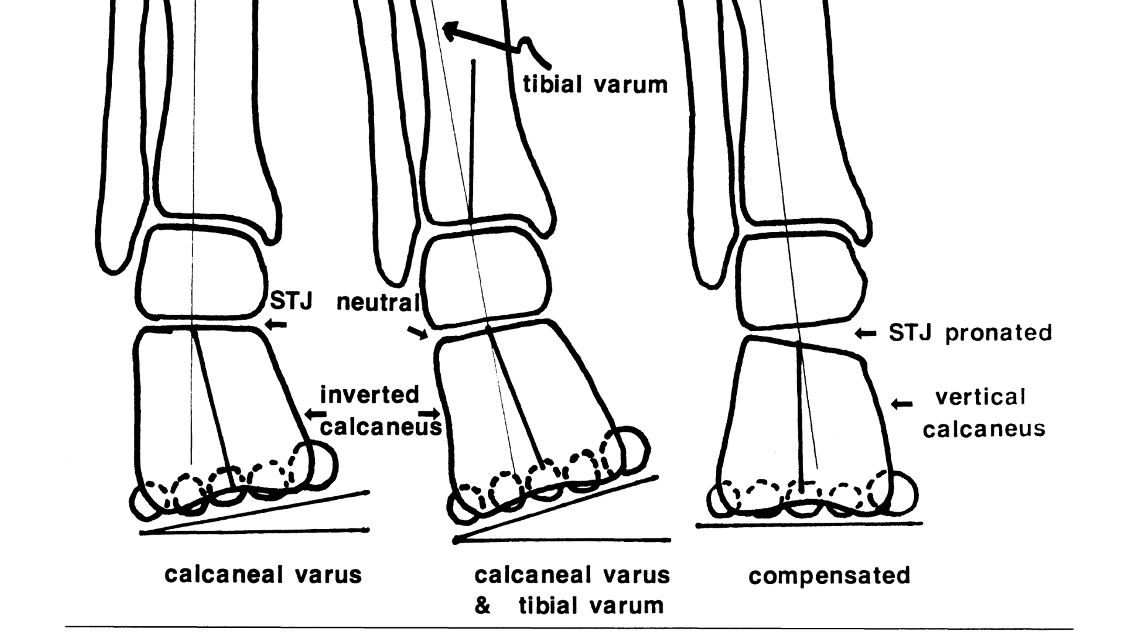 Pathomechanics of Structural Foot Deformities