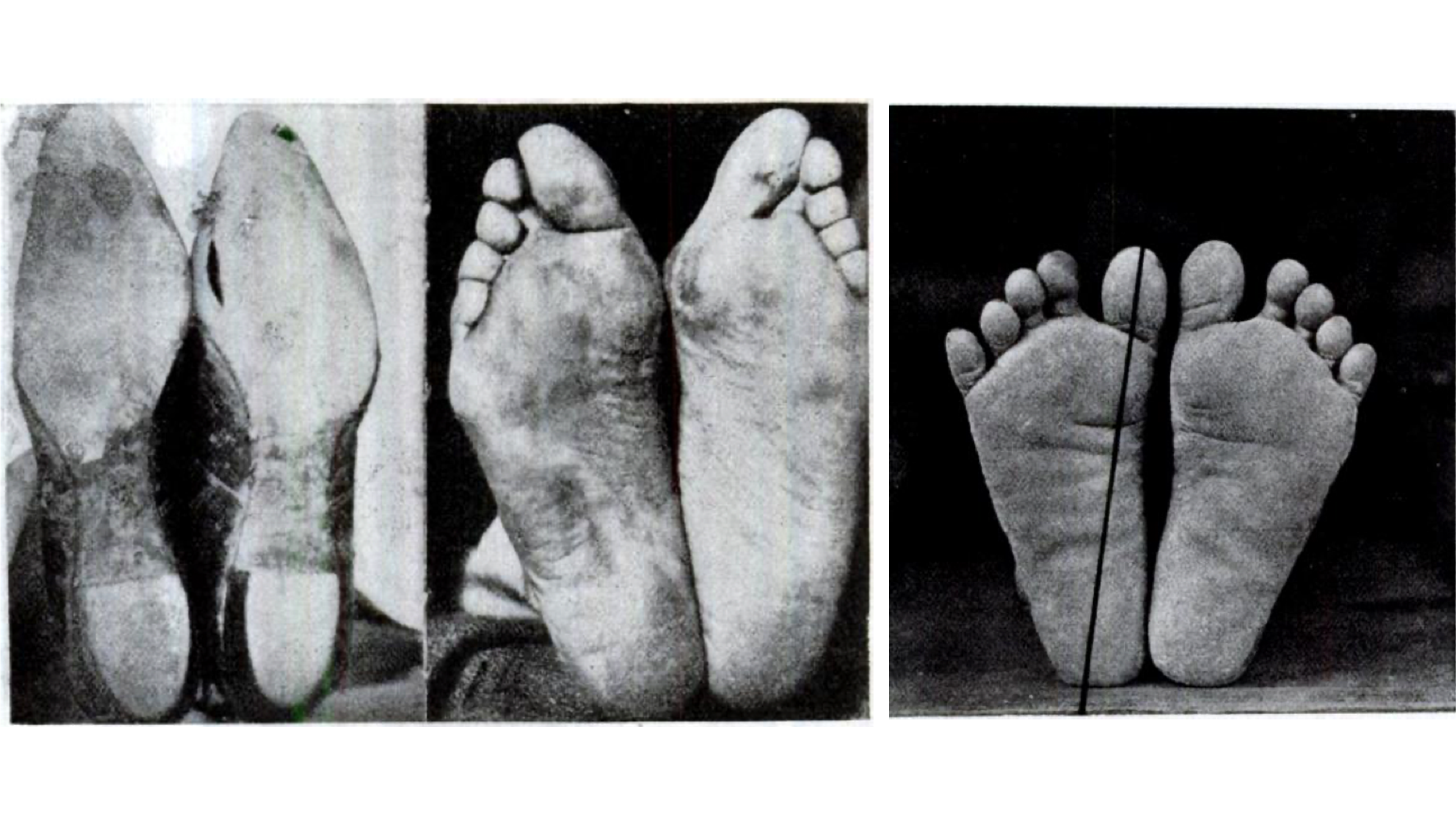 Comparison between shoe wearing population and barefoot