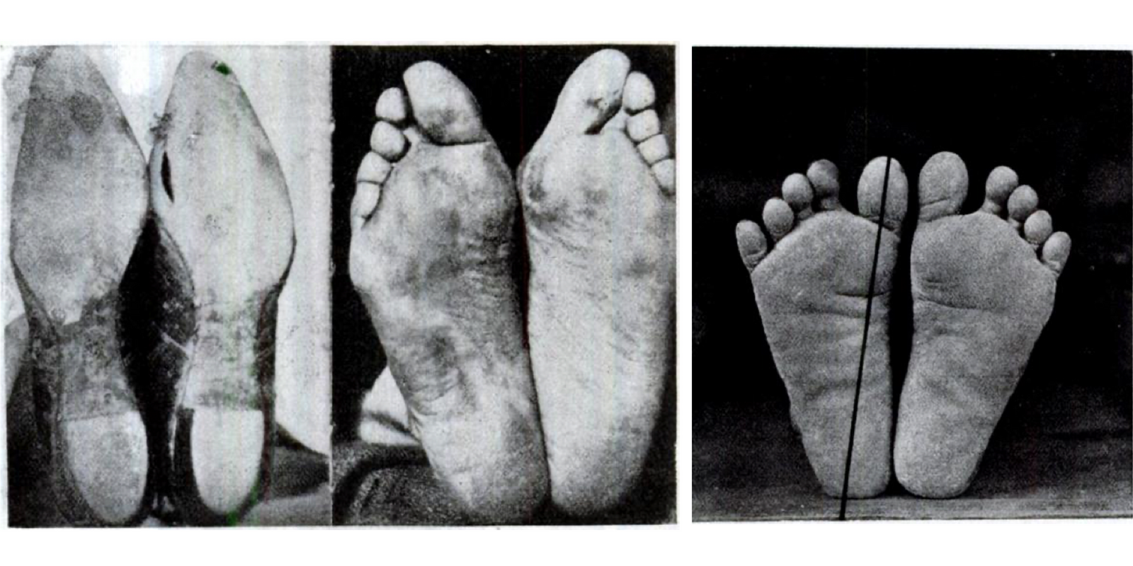 Comparison between shoe wearing population and barefoot