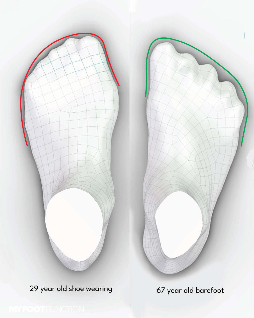 Impacto del calzado en la forma y función del pie: